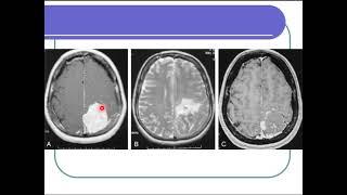 Introduction to interventional neuroradiology