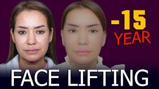 FACE LIFTING -15 YEAR ПОДТЯЖКА ЛИЦА -15 ЛЕТ YUZ TORTTIRISH -15 YOSH