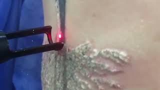 Eliminación de tatuajes con tratamiento láser