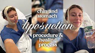 I GOT CHIN AND STOMACH LIPOSUCTION!! PROCEDURE & HEALING PROCESS