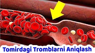 Qon Tomirlarda Tromblar Paydo Bo‘lganidan Darak beruvchi 7 ta Belgi - Doktor maslahati !!!