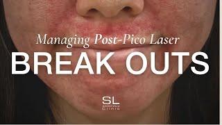 The Ultimate Guide to Managing Post Pico Laser Breakouts