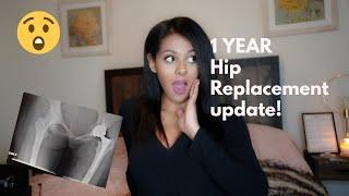 Major Surgery | 1 year Hip Replacement Update