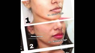 Lip augmentation