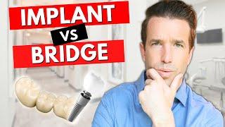 Dental Implants vs Bridges for a Missing Tooth