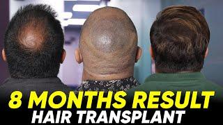 Hair Transplant in Maldives | Best Results & Cost of Hair Transplant in Maldives