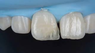 Реставрация переднего зуба композитом Capo Natural (Schutz). Front tooth composite restoration.