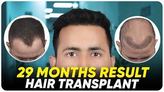 Hair Transplant in Indore | Best Results & Cost of Hair Transplant in Indore