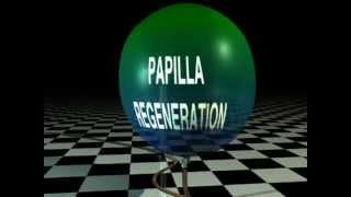 Papilla Reconstruction Animation By Peter Nordland D.M.D, M.S.