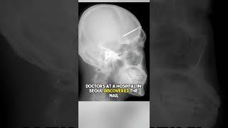 The Most Disturbing X-Ray Images In History #medicine #interesting #science #horror