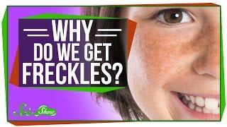 Why Do We Get Freckles?