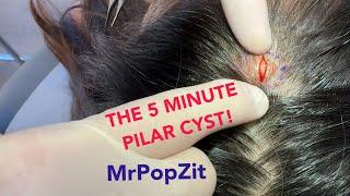 Hard boiled Egg or Pilar Cyst?You make the call. Popped out in under 5 minutes!2 week suture removal