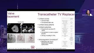 SAT 15 10 Wendy Tsang – Percutaneous TV Interventions