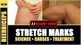 GOODBYE FOREVER - Stretch Marks | Stretch Marks Science, Causes & Treatment | BeerBiceps