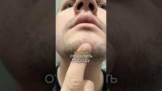 Миноксидил для бороды, результат за месяц