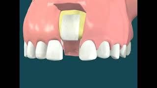 Dental Video for  Tooth Grafting with Titanium Membrane - The Tooth