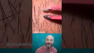A funny story time to go with this hair plucking video (credit: @pluckwhisperer on TT) #ingrownhair
