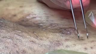 Ingrown hair removal - intimate zone