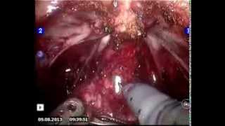 surgeon K: apex urethra