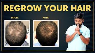 #AskDrJohnWatts | Regrow your hair | Hair Specialist Explains