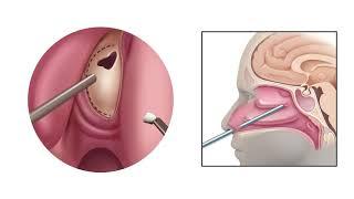 Endoscopic Endonasal Approach for Pituitary Tumor Removal
