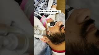 Acne Scars Treatment | #Shorts | #YouTubeShorts | #VideoShorts | Dadu Medical Centre