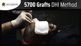 5700 Grafts DHI Hair Transplant / DHI Hair Technique in Turkey