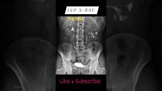 X ray kub ipv test