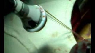 Aortic valve suturing technique