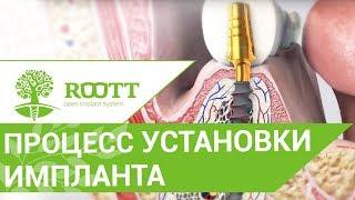 Установка зубных имплантов.  Как происходит установка зубных имплантов. Клиника ROOTT