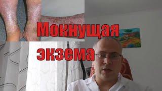 Мокнущая экзема - фото, симптомы, лечение мокнущей экземы