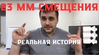 Смещение 23 мм! Упражнение, которое спасло. Реальная история