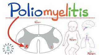 Poliomyelitis - Paralysis - Anterior Horn Cell (AHC) disease- Hypotonia, Weakness - Neurology