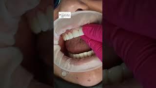 Smile Makeover: Fixing Missing Teeth with Veneers  #dentist
