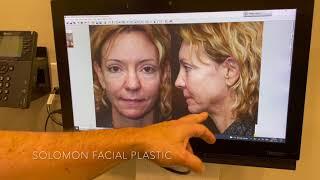 Facelift Surgery Before and After Results by Dr. Philip Solomon in Toronto