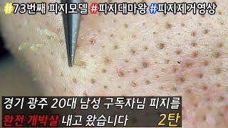 피지 직접 뽑아드렸습니다 _ 피지제거 블랙헤드제거 피지뽑기 _ 경기 광주시에 사는 20대 남자구독자님의 쫀쫀한 피지 정복 프로젝트 2탄