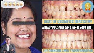 Amazing Smile Makeover in Just 12 hours - Best Cosmetic Dental Treatment | Cosmetic Smile Designing