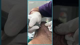How to Reverse White Beard Prematurely | White Beard Treatment | AWISH Clinic
