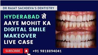 Digital Smile Makeover in Delhi |  Fluorosis Treatment by Veneers | Delhi Dentist |