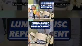 Quick update on disc replacements! (Texan Spine Surgeon Explains)