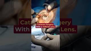 Cataract surgery with a trifocal lens - Dr. Advaith Sai Alampur | Envision LASIK Centre