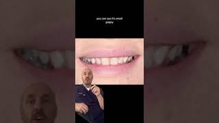 No Prep Veneers At SmileTexas