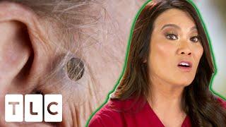 Dr. Lee Is Excited To Remove A 55-Year-Old Blackhead! | Dr. Pimple Popper: 12 Pops Of Christmas