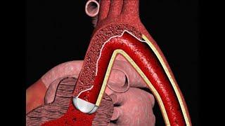 Aortic Dissection and Cardiac Tamponade