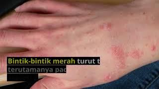 Kenali Penyakit Kudis Buta (Scabies)