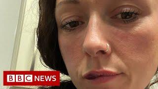 Botox injections and lip fillers banned for under-18s in England - BBC News