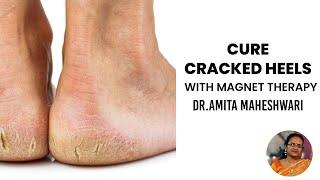 Video 52 - Cure Cracked heels with Dr. Amita Maheshwari