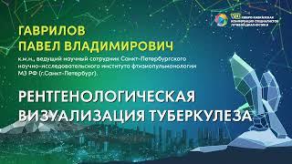 51  Рентгенологическая визуализация туберкулеза   Гаврилов Павел Владимирович