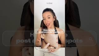How To Fade Acne Scars AKA Post Inflammatory Hyperpigmentation #acnescars #darkspots #acnescarring