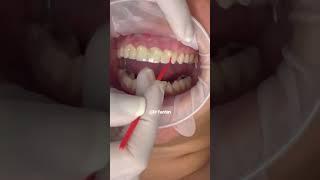 Smile makeover procedure #cosmeticdentistry | dental crown procedure front teeth | Dr. Yazdan